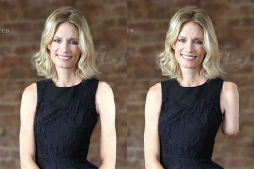 Split screen image showing woman in black dress both with and without a left forearm