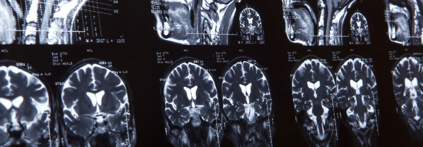 Brain MRI scan