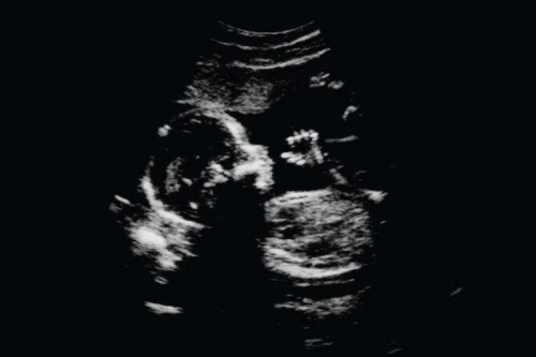 Baby scan in pregnancy